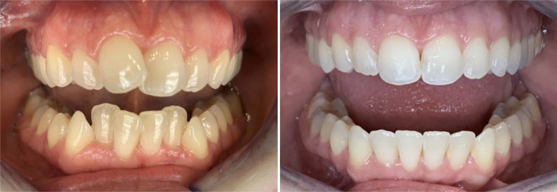 Invisalign BA image